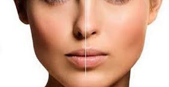 La rinoplastia