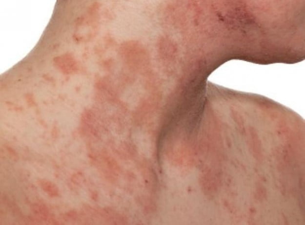 dermatitis atopica